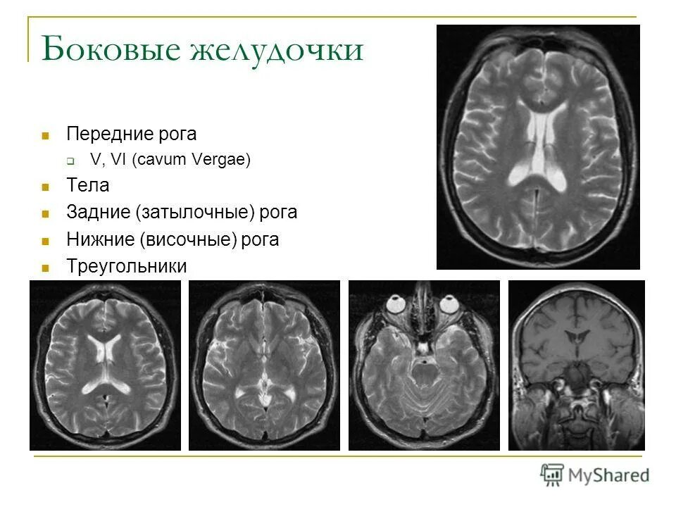 Боковые желудочки анатомия кт. Затылочный Рог бокового желудочка. Треугольник бокового желудочка. Височный Рог бокового желудочка.