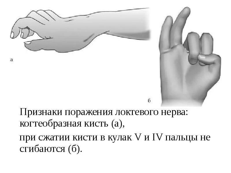 Клинические проявления поражения локтевого нерва. Положение кисти при невропатии локтевого нерва. Симптомы поражения локтевого нерва нерва. Положение кисти при поражении локтевого нерва.