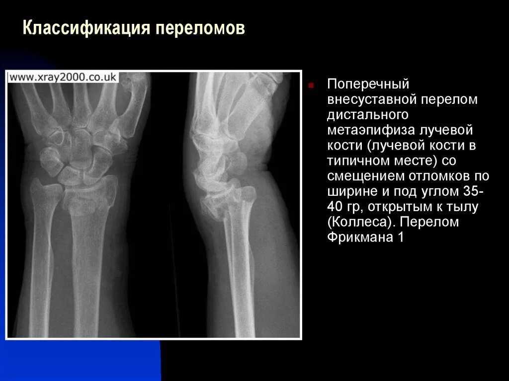 Диагноз перелома лучевой кости. Классификация переломов дистального метаэпифиза лучевой кости. Перелом внесуставной перелом дистального метаэпифиза лучевой кости. Внутрисуставной перелом метаэпифиза лучевой кости. Перелом луча в типичном месте рентген.