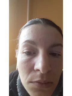 Лимфомиозот после ботокса