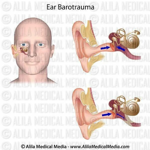 Симптомы баротравмы среднего уха. Баротравма уха лечиться. Баротравма это простыми словами в медицине