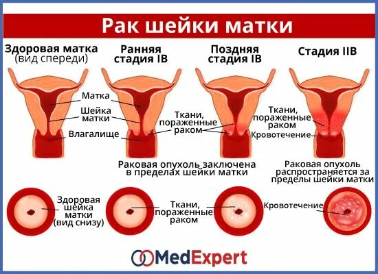 Как распознать рак матки. Признаки онкологии шейки матки. симптомымоака шейки матки. симптомы ракмшейки матки. рк шейки матки симптомы.