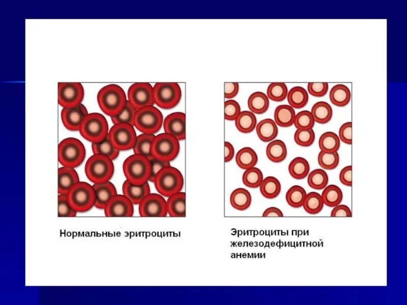 Здоровый эритроцит. Эритроциты при железодефицитной анемии. железодефицитная анемия клетки крови. гипохромия это в крови. жда анемия гипохромная.