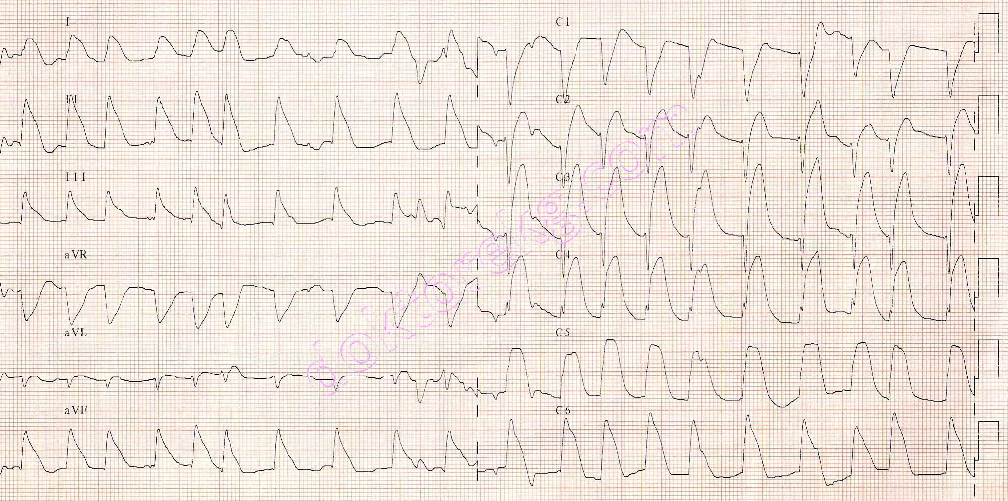 Ранние и поздние осложнения при инфаркте миокарда. Аритмия при инфаркте миокарда. Инфаркт миокарда мерцательная аритмия на экг. Ранние и поздние осложнения инфаркта миокарда. Классификация нарушений ритма.