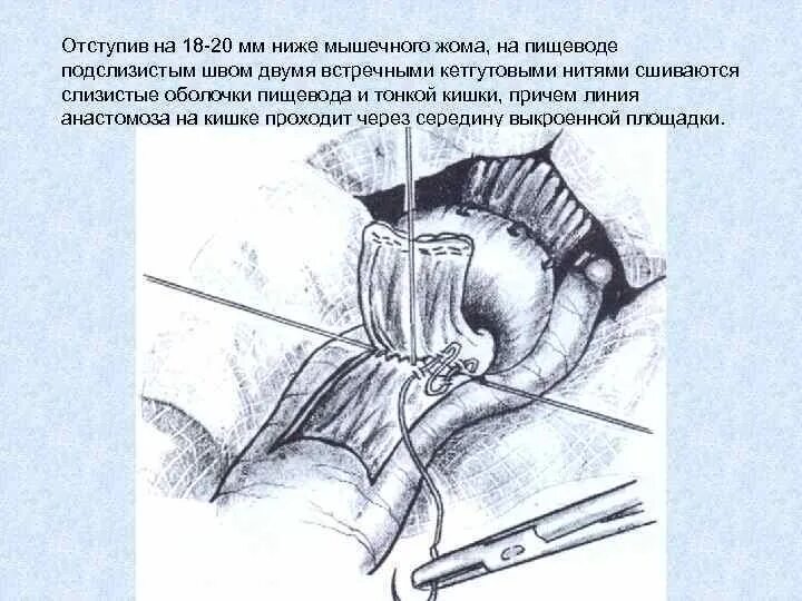 Аппаратный анастомоз кишечника. Экстракорпоральный анастомоз кишечника. Антиперистальтический анастомоз.