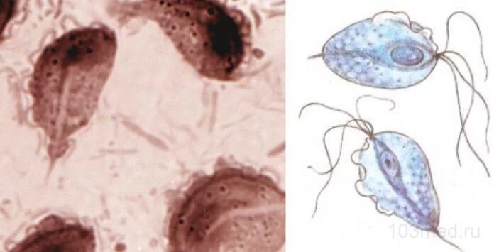 Трихомоноз у мужчин симптомы. Влагалищная трихомонада. Урогенитальный трихомониаз. Трихомонадный кольпит.