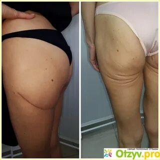 Липосакция ног до и после
