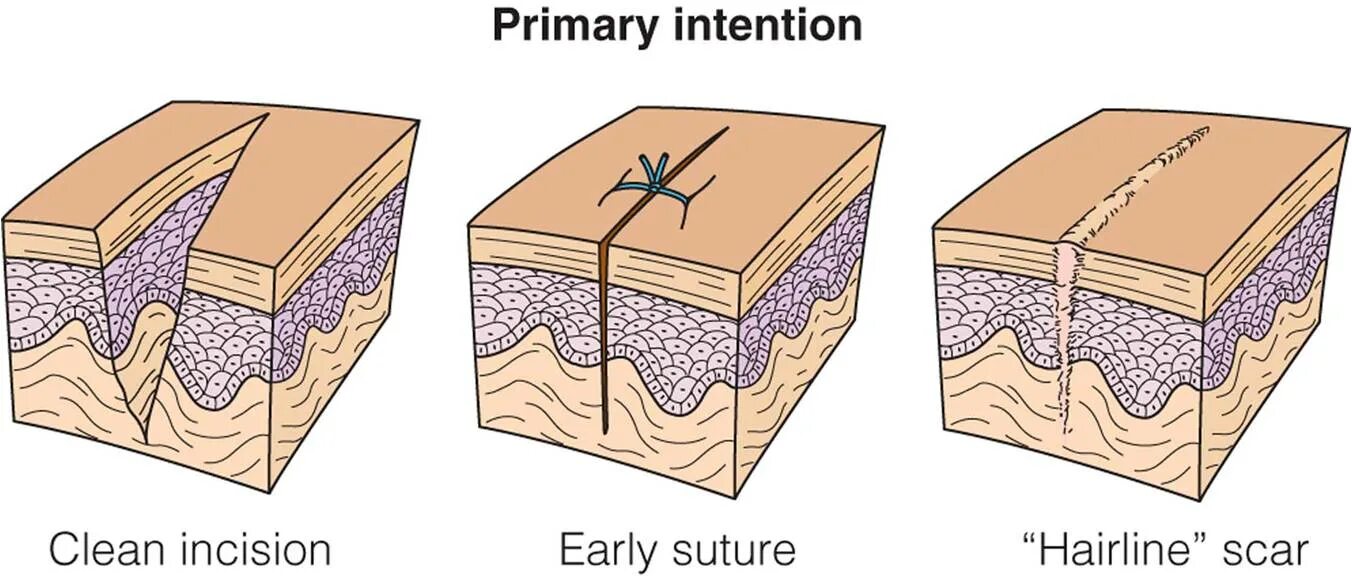 What is a wound. Wound healing with polymers. wounded healer.