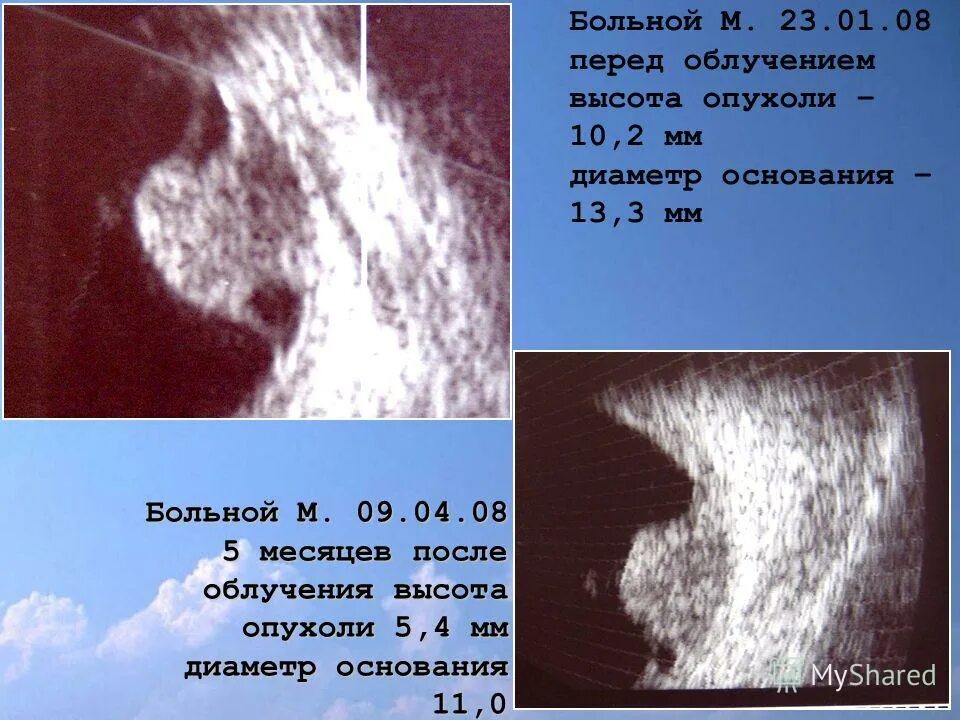 Радиация на высоте. Сосок после лучевой терапии. Лучевое лечение новообразования глаза. Радиоэксцизия новообразования глаза. Воспаление кожи груди после протонного облучения.