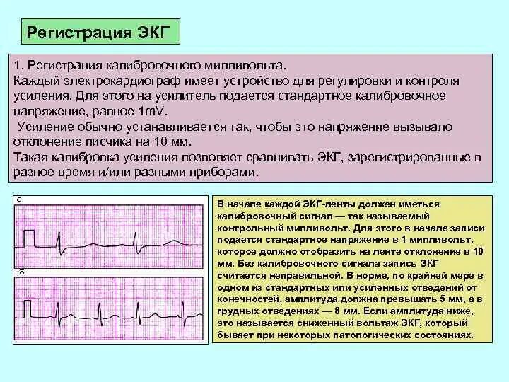 Электроды отведения ЭКГ. Электроды ЭКГ при декстрокардии. Методика регистрации ЭКГ. Электрокардиография методика регистрации ЭКГ. В каких условиях необходимо проводить исследование экг