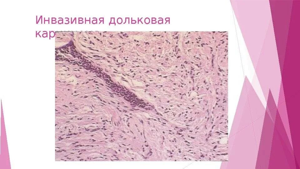 Протоковая карцинома молочной железы микропрепарат. Инфильтрирующая карцинома молочной железы гистология. Дольковая карцинома молочной железы гистология. Дольковая карцинома молочной железы микропрепарат
