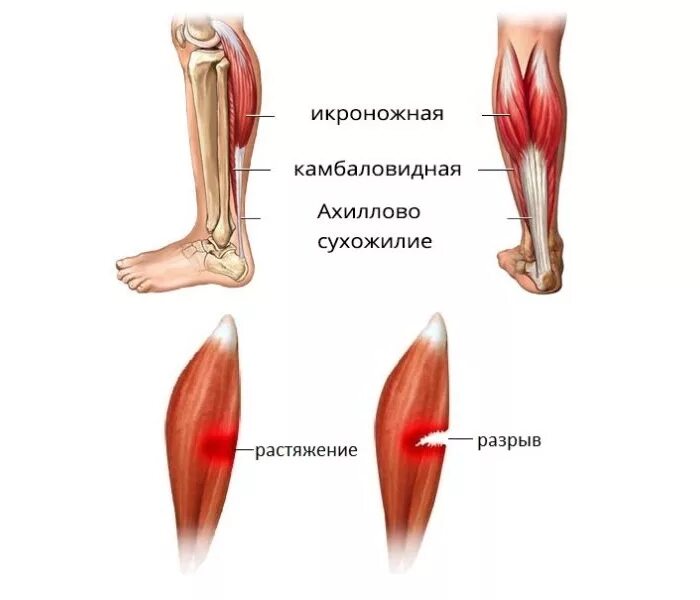 Разрыв мышц признаки. Растяжение связок икроножной мышцы. Строение икроножной мышцы. Надрыв икроножной мышцы симптомы. Растяжение голени мышцы икроножной.