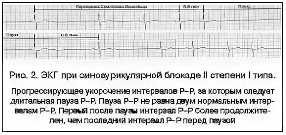 Блокада инструкция. Синоаурикулярная блокада на ЭКГ. Синоатриальная блокада Мобитц 1 ЭКГ. Синусовая блокада 2 степени ЭКГ. Синоаурикулярная блокада 2 степени.