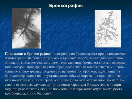Бронхография