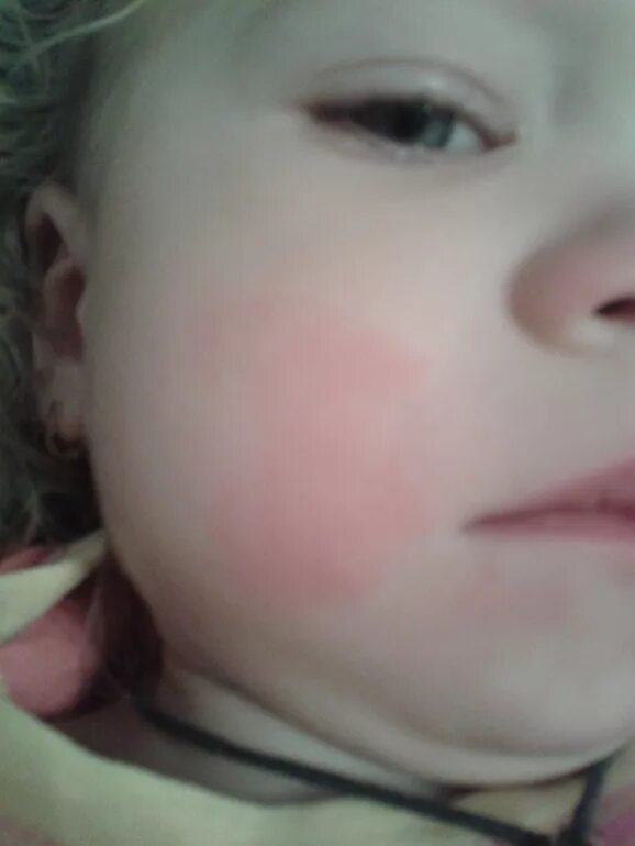 Ребенку год красные щеки. Покраснение на щеке у ребенка. Красные щеки у ребенка 1 год.
