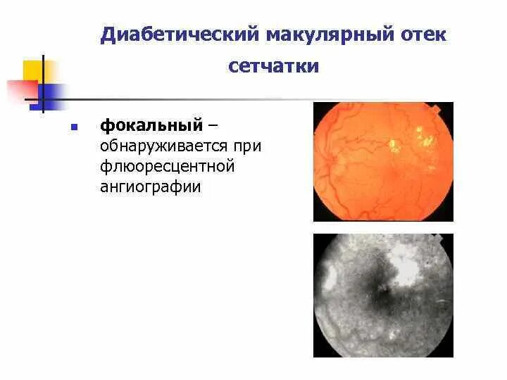 Макулярный отек лечение. Макулярный отек сетчатки глаза. Кистовидный макулярный отек сетчатки. Диабетический макулярный отек сетчатки. Фокальный макулярный отек.