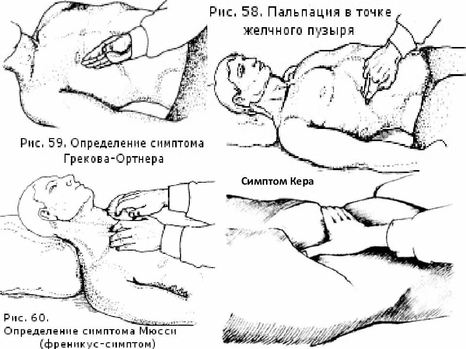 Пальпация при остром животе. Симптомы Ортнера Мерфи Мюсси. Симптом Ортнера Кера Мюсси Мерфи. Точки пальпации желчного пузыря. Симптомы Кера Мерфи Ортнера.