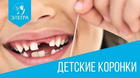 Коронки детям на молочные