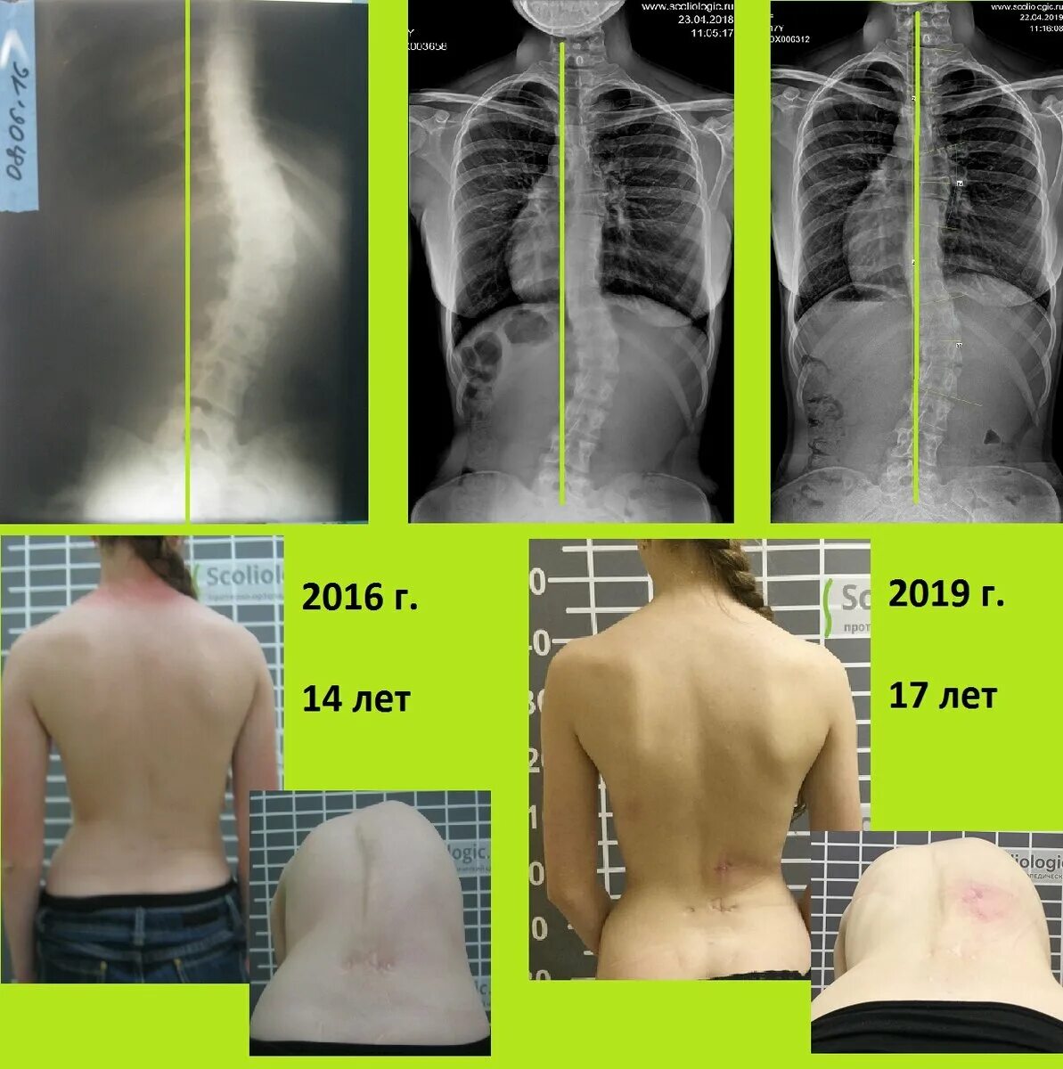 Операция на сколиоз вид сбоку. Сколиоз 2 степени вид сбоку. Сильное искривление позвоночника. Сколиоз позвоночника s образный. Сколиоз 2 степени это