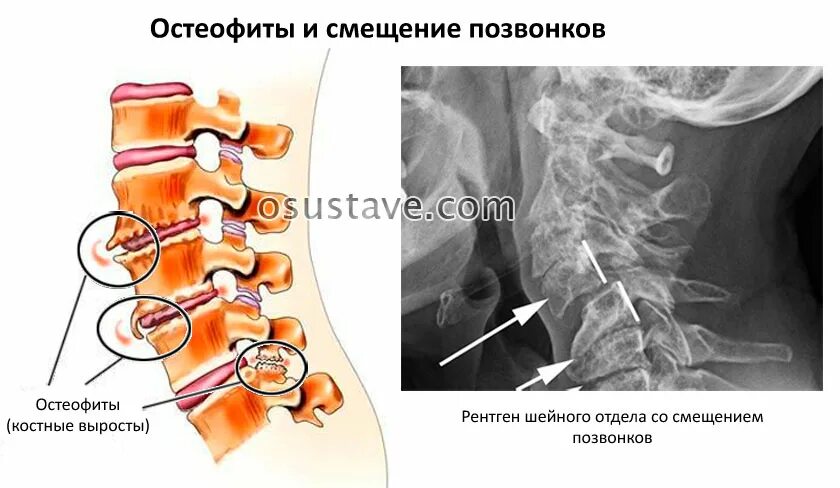 Костные остеофиты l2-s1. Остеофиты шейного отдела позвоночника рентген. Остеофиты тел позвонков рентген. Задние остеофиты с5 с6.