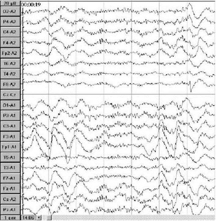 Дельта волны на ЭЭГ. Высокоамплитудные Дельта волны на ЭЭГ. Высокоамплитудная Дельта активность на ЭЭГ. Вспышки Дельта волн на ЭЭГ.