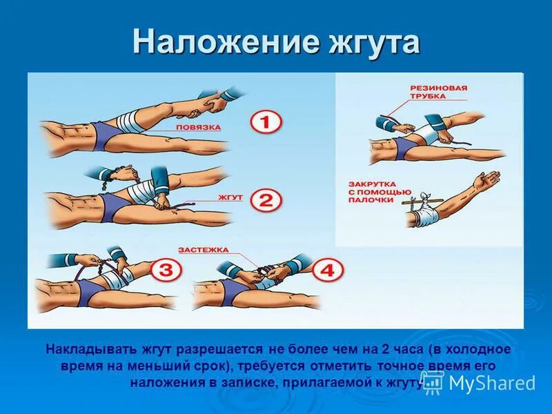 Сколько держать артериальный жгут. Методика наложения жгута при кровотечениях. Наложение жгутов при отеке легких алгоритм. Наложение венозных жгутов алгоритм. Техника наложения жгута при венозном кровотечении.