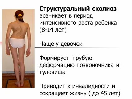Сколько рост сколиоз