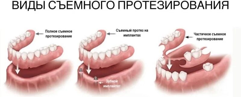 Съемные зубные протезы в СПб Клиника "Премьера"