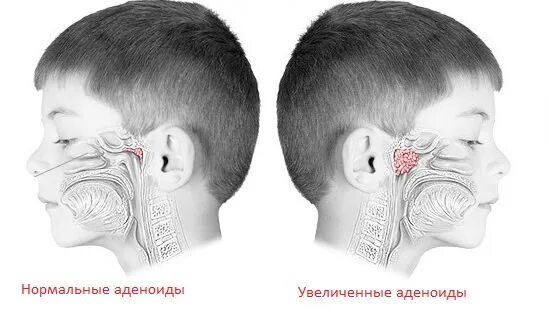 Что делать при аденоидах. Аденоиды 2 степени аденоидит. Аденоиды 2-3 степени у ребенка. Аденоиды 2 степени у ребенка. Аденоиды 3 степени у ребенка.
