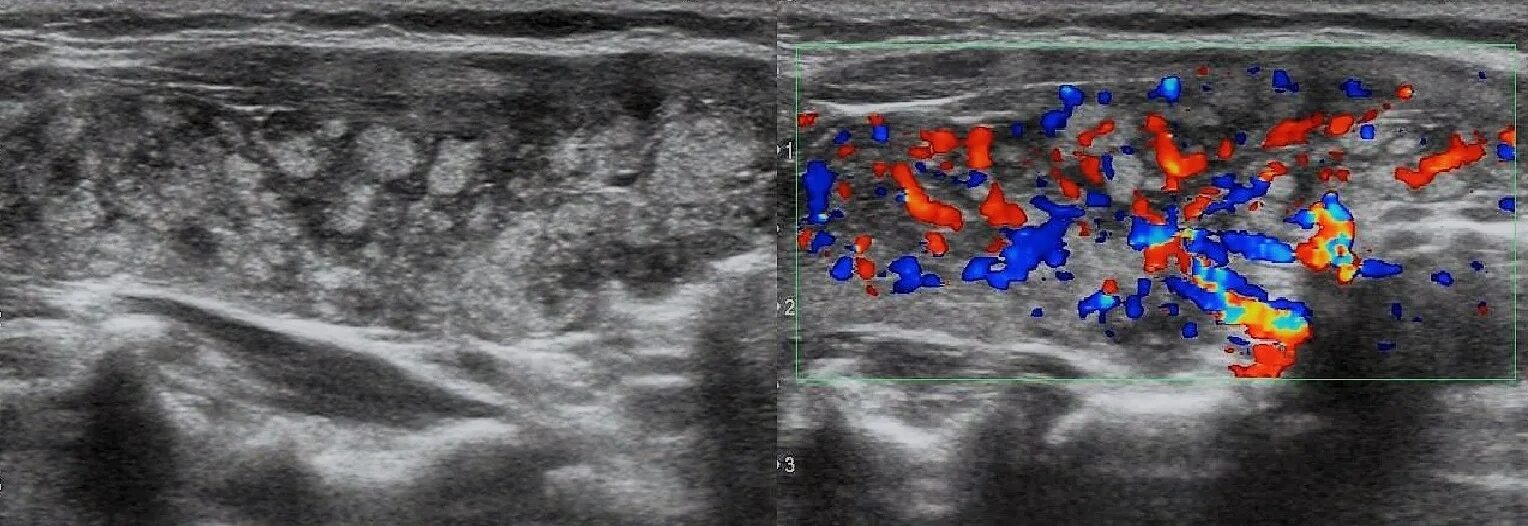Подострый тиреоидит на УЗИ. Тиреоидит щитовидной железы на УЗИ. Тиреоидит щитовидной железы УЗИ картина. Тиреоидит Хашимото щитовидной железы на УЗИ. Щитовидная железа изменения на узи