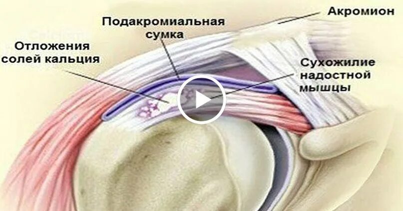 Соль в суставах симптомы. Отложение солей в плечевом суставе. надостное сухожилие. отложение солей в суставах.