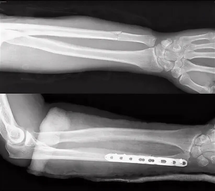 Остеосинтез плечевой кости. Остеосинтез дмэ лучевой кости. Сроки сращения костей таблица. Перелом костей предплечья рентген. Костная мозоль большеберцовой кости рентген.