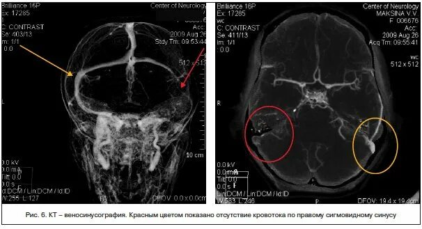 Гипоплазия правого поперечного синуса. Тромбоз сигмовидного синуса на кт. Тромбоз венозного синуса на мрт. Тромбоз поперечного венозного синуса на мрт. Тромбоз сигмовидного синуса мрт.