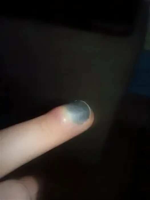 Можно ли прищемить