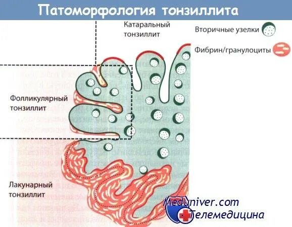 Мкб хронический тонзиллит код 10 у взрослых. Тонзиллит патоморфология. острая фолликулярная ангина мкб.