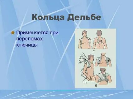 Кольца при переломе ключицы