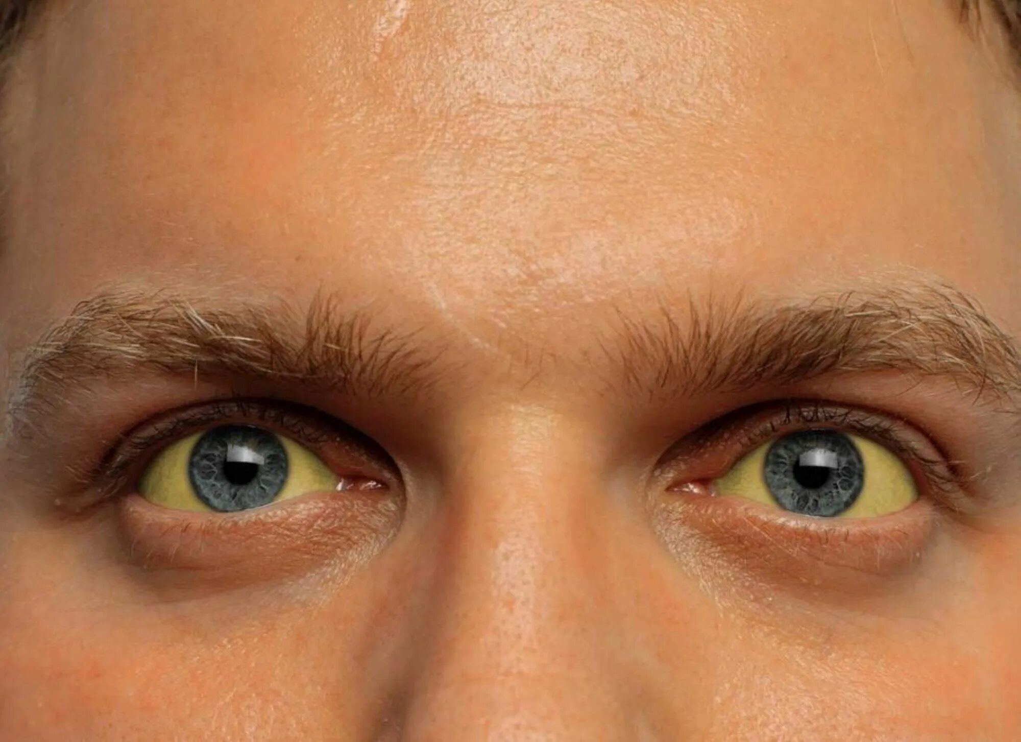 Пожелтение склер гепатит. Глаз человека. Почему глаза желтоватого
