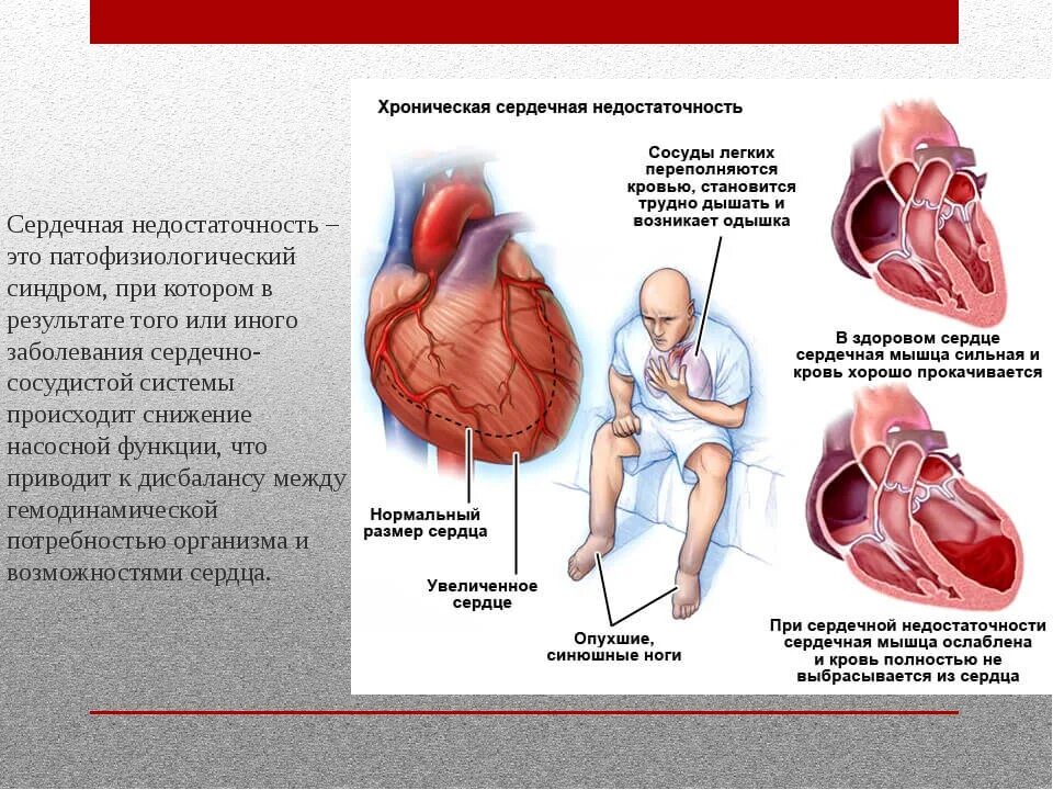 Сердечная недостаточность что хорошо. Сердечно недостаточность. Сердечная недостаточность. Хроническая сердечно-сосудистая недостаточность. Хронической сердечной недостаточности.