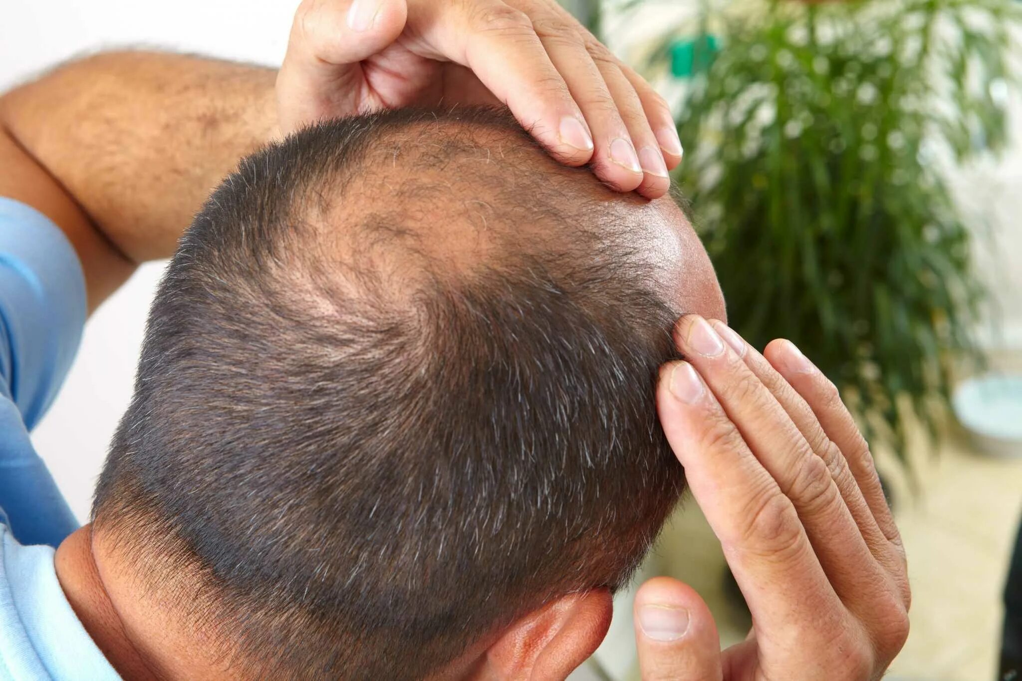 Выпадение волос головы причина лечение