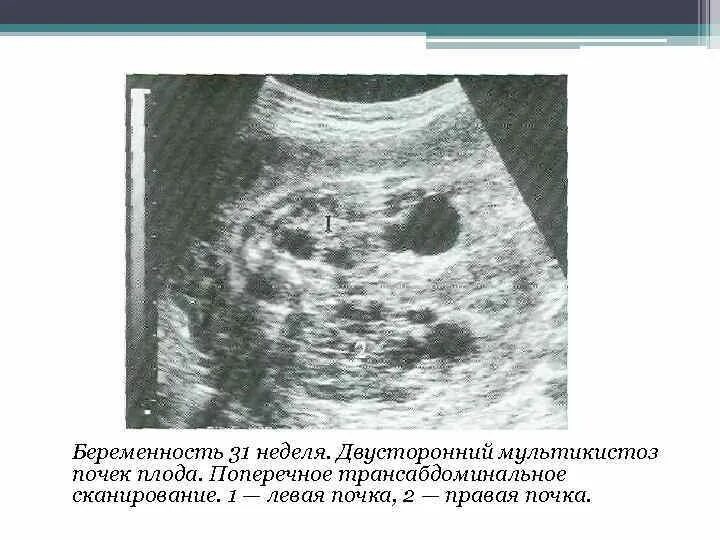 Мультилокулярная киста почки на узи. Кисты почки плода. Кисты почки плода. Мультикистоз почки у плода. Парапельвикальные кисты почек что это такое.