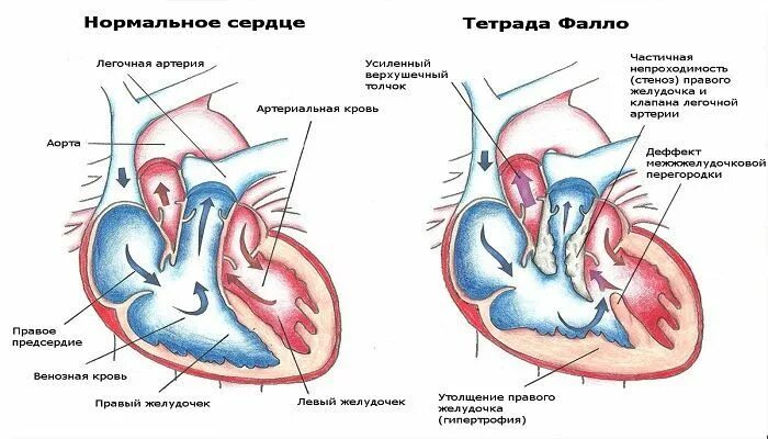 Какая кровь в левом желудочке сердца. Единый желудочек сердца. Стенки левого желудочка сердца. Артериальный конус левого желудочка. Трабекула левого желудочка.