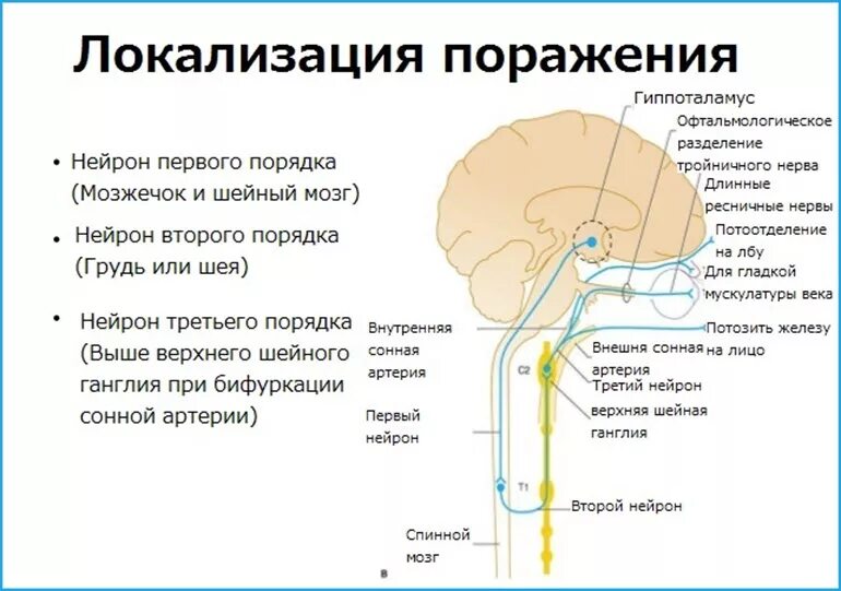 Синдром горнера это. Синдром горнера (поражение зрительного аппарата). локализация поражения. синдром клода бернара горнера неврология. синдром горнера локализация.