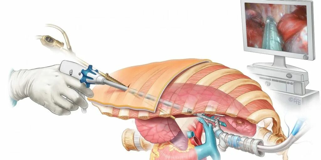 Эмпиема плевры торакоскопия. Торакоскопия операция. Торакоскопия (плевроскопия). Торакоскопия и видеоторакоскопия.