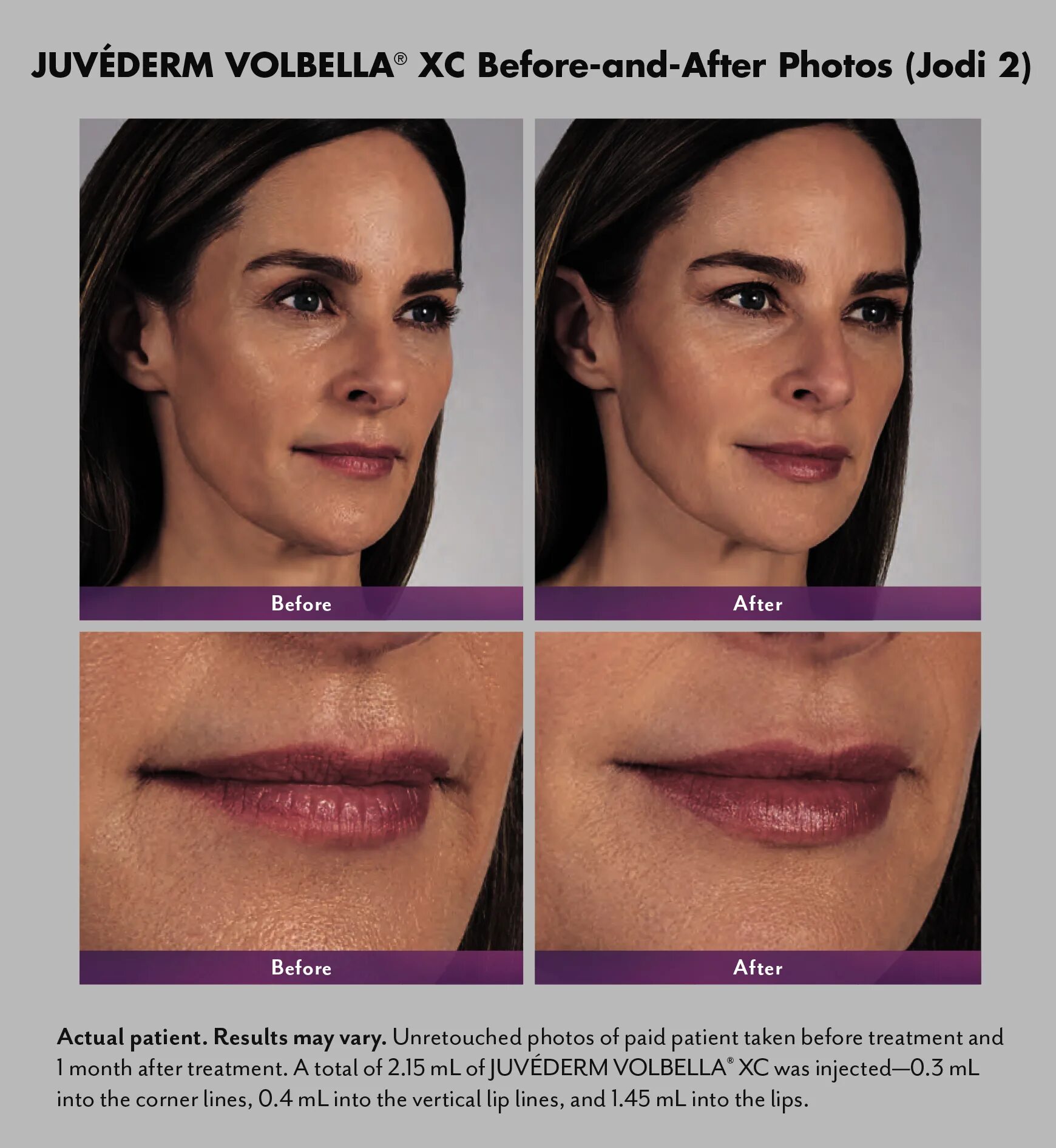 Биоревитализация губ до и после. Ювидерм Volbella. Voluma Juvederm губы. Филлеры Ювидерм 1.