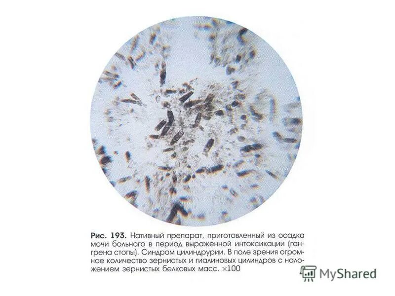 Бактерии в копрограмме. Микроскопия кала растительная клетчатка непереваримая. Микроскопия кала копрограмма. Микроскопия нативного препарата мочи. Лейкоциты в нативном препарате.