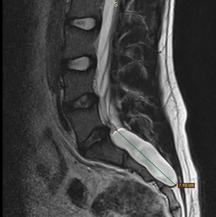 периневральная киста шейного отдела. периневральная киста шейного отдела. периневральная киста шейного отдела. периневральная киста на уровне s2 позвонка на мрт. сирингомиелия на мрт шейного отдела.