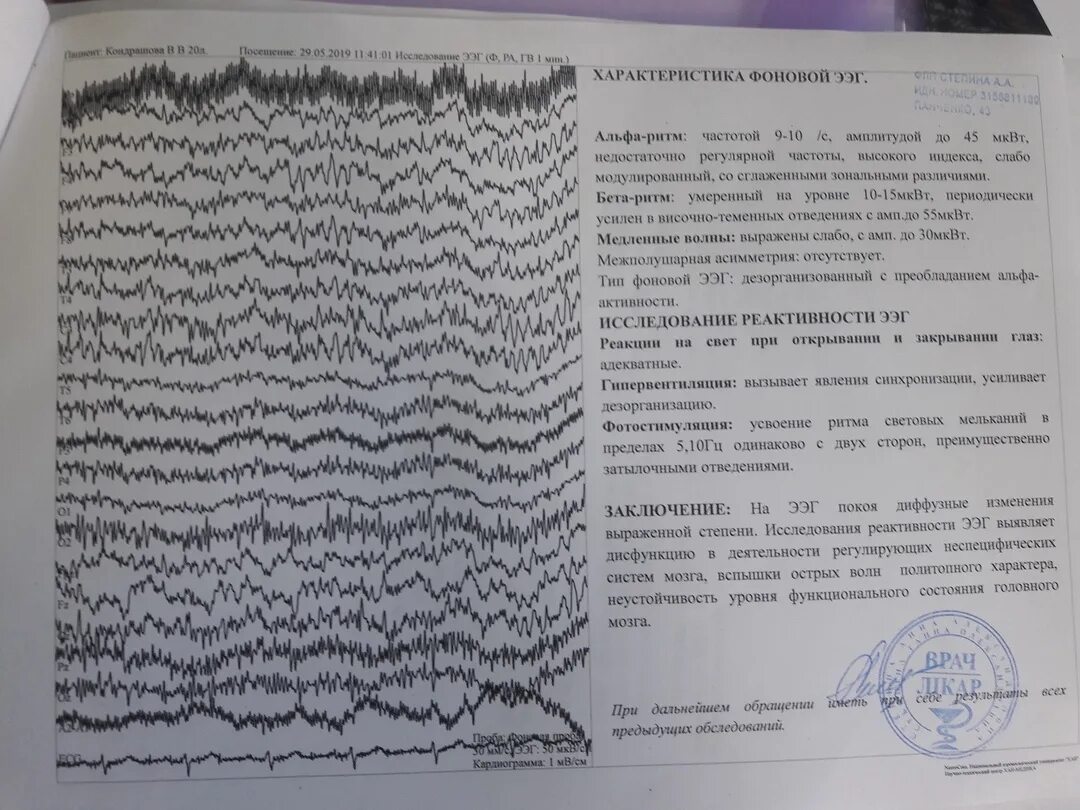 Дезорганизованный тип ээг. Острые волны на ЭЭГ. Электроэнцефалография книги 2022.