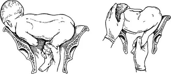Тазовое предлежание плода кесарево. Наружный поворот плода при тазовом. Поперечное ножное предлежание плода. Наружный акушерский поворот при поперечном положении. Поперечное положение плода поворот.
