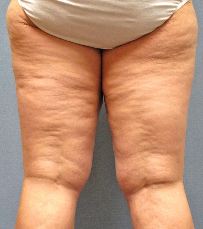 Целлюлит у знаменитостей русских. Целлюлитные ноги и ягодицы. Русский целлюлит. Липодистрофия целлюлит. Рози хантингтон целлюлит.