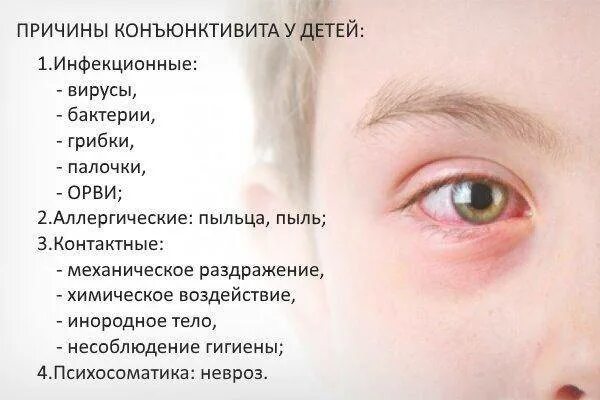 Как быстро вылечить коньюктивит у ребенка